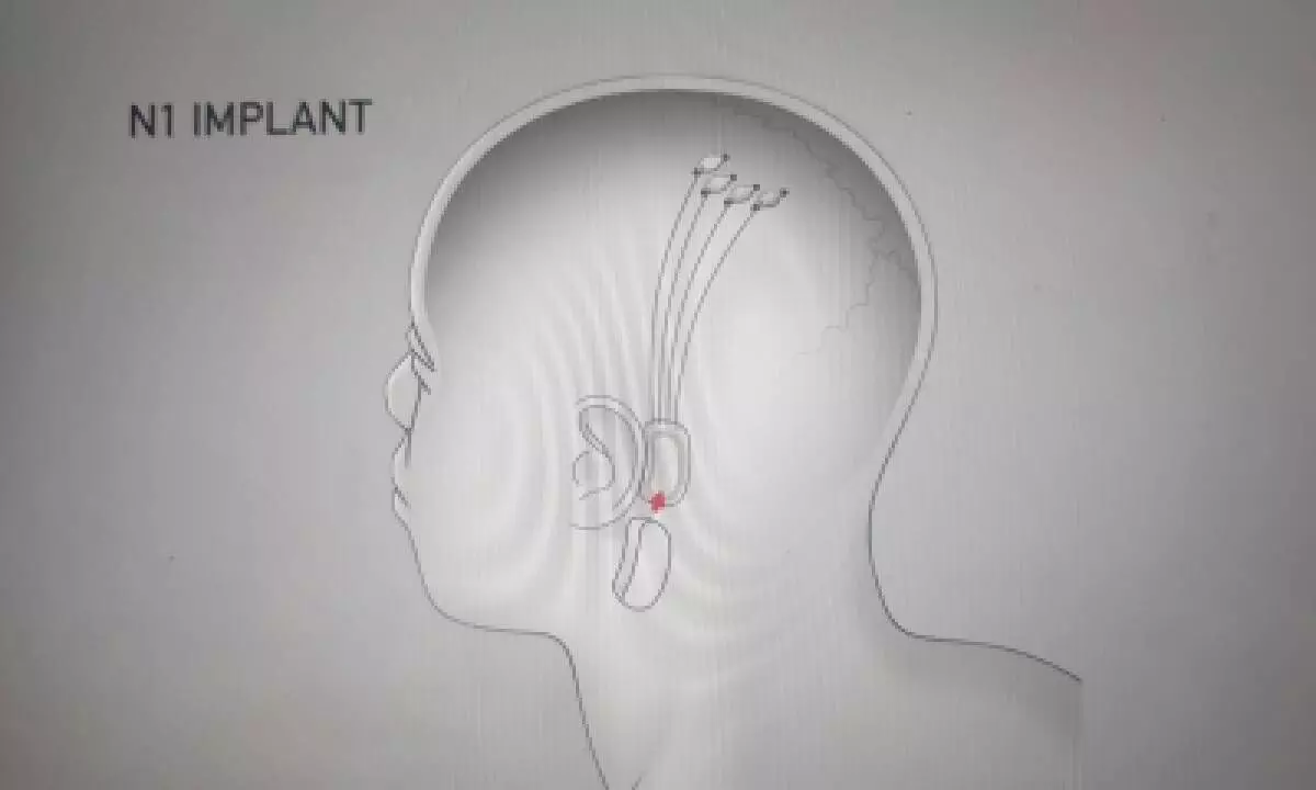 Musk’s Neuralink now recruiting for 1st human trial of its brain-computer interface