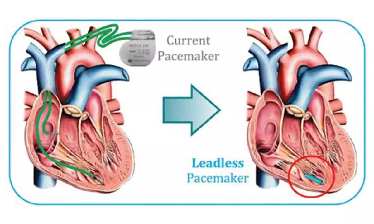 A leadless pacemaker that precisely stimulates multiple areas of the heart is in the offing