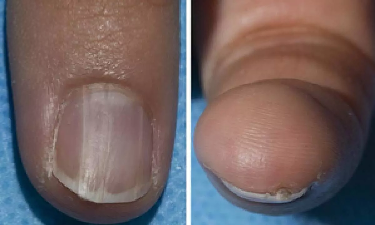 How your nail colour can signal cancer risk