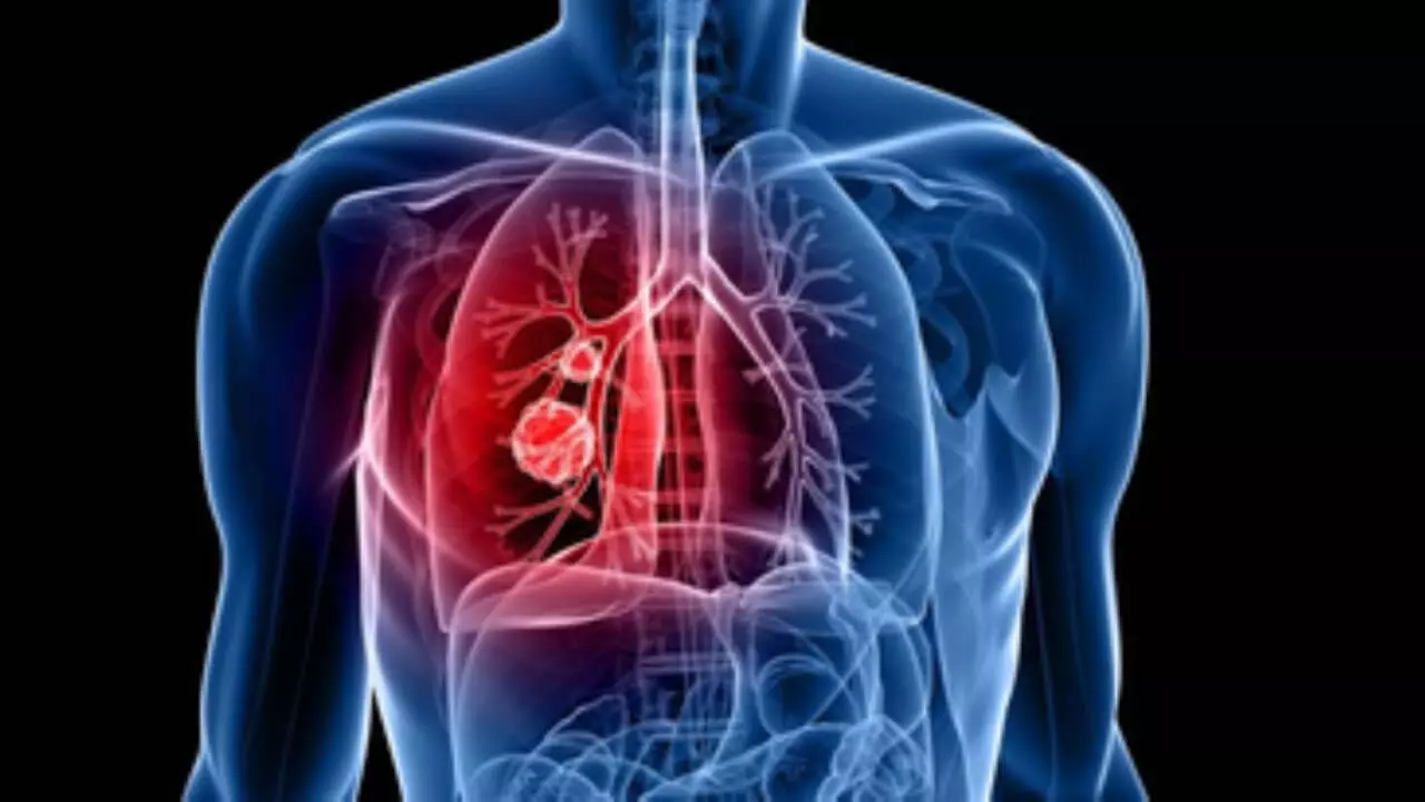 Lung cancer most common cancer can to spread to brain