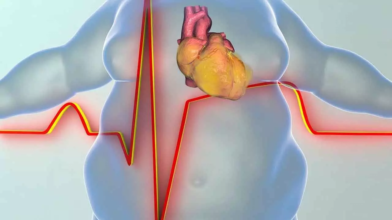 Study finds link between obesity, and heart failure