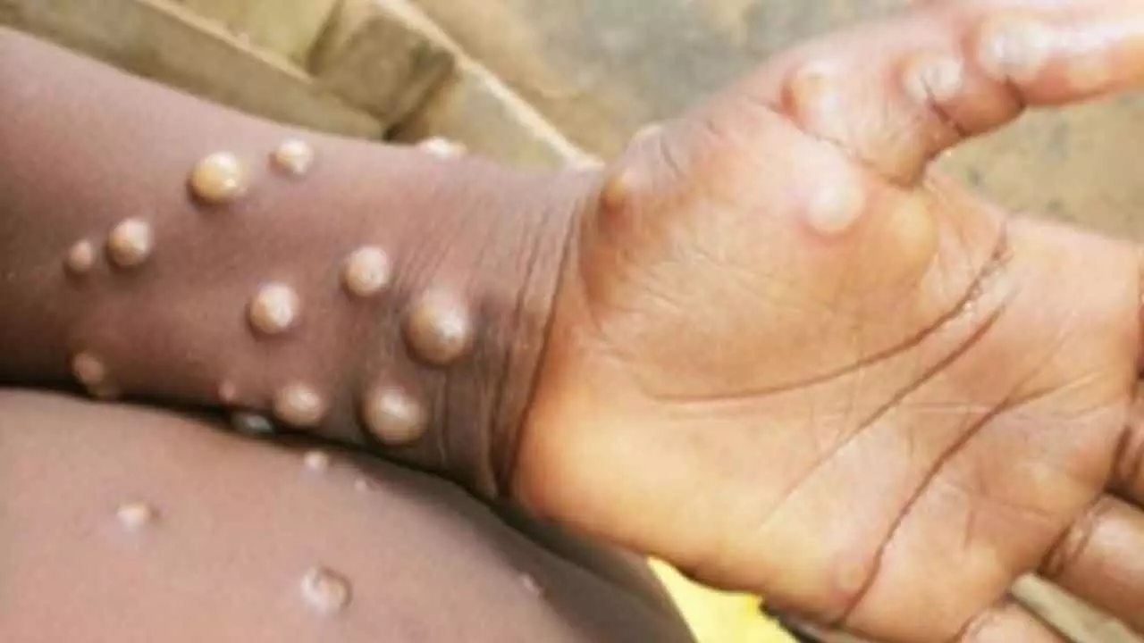 Mpox impacting a broader demographic: Lancet Report