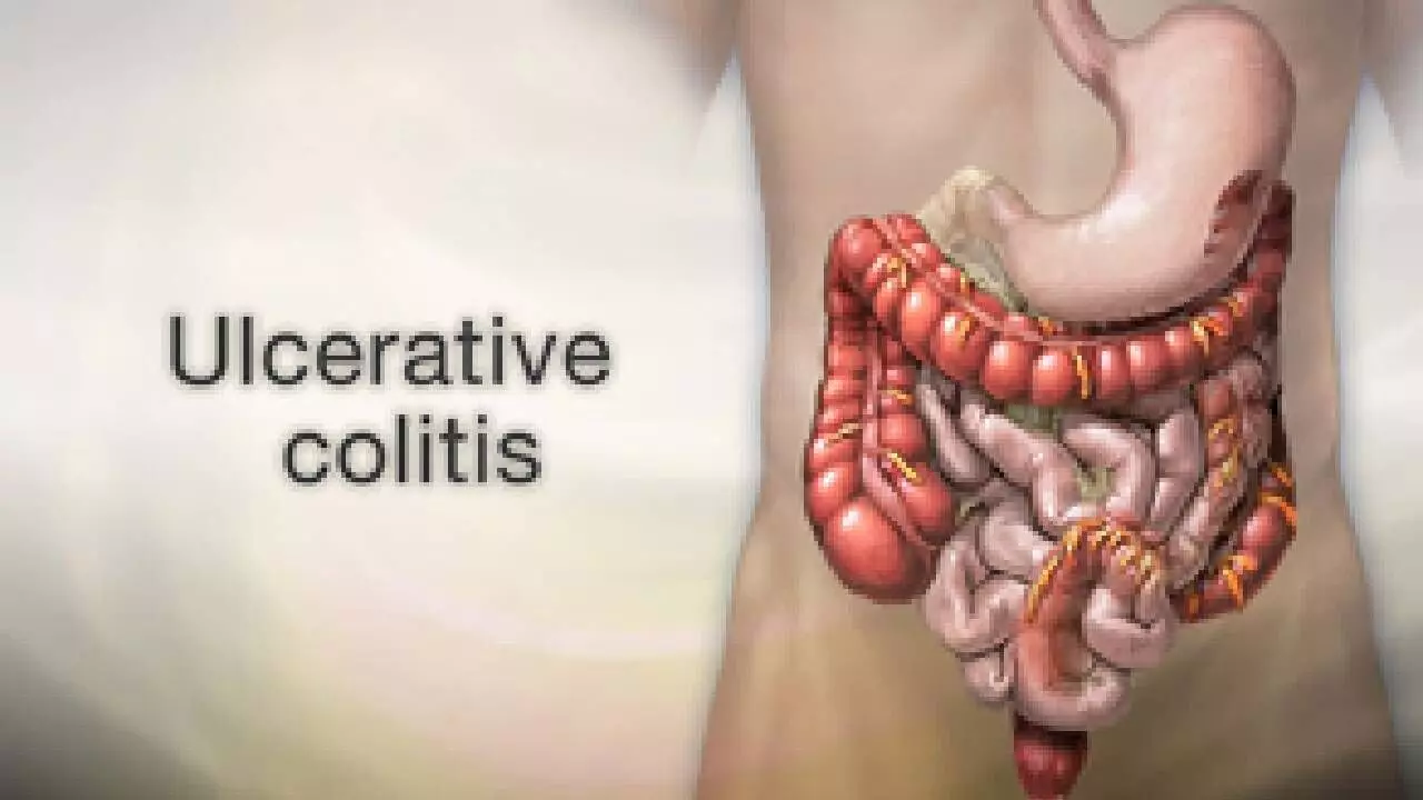 Scientists link colon cancer risk to specific gene in ulcerative colitis