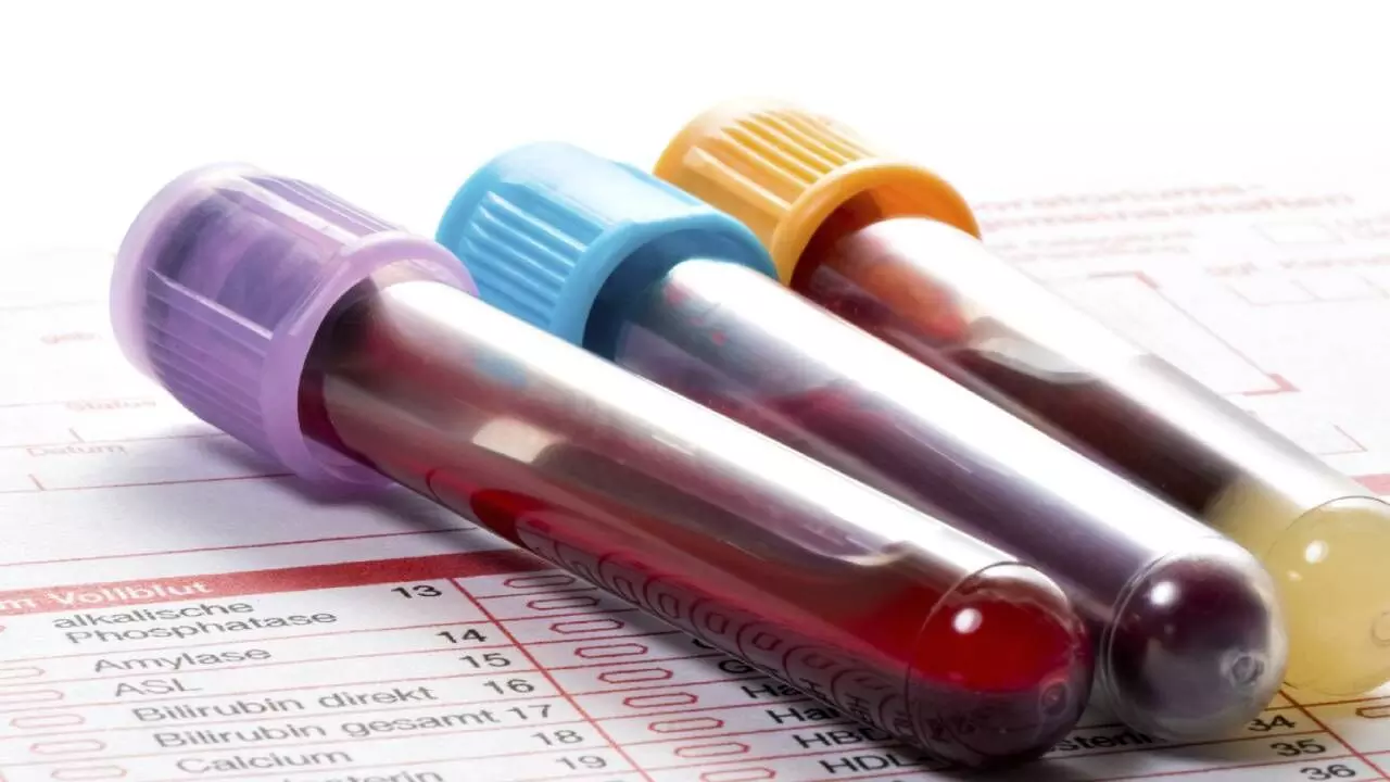 Blood-biomarker tests may aid in early diagnosis of Alzheimer’s: Report