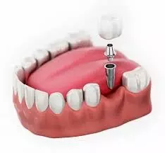 Benefits and Insights of Dental Implants for a Confident Smile