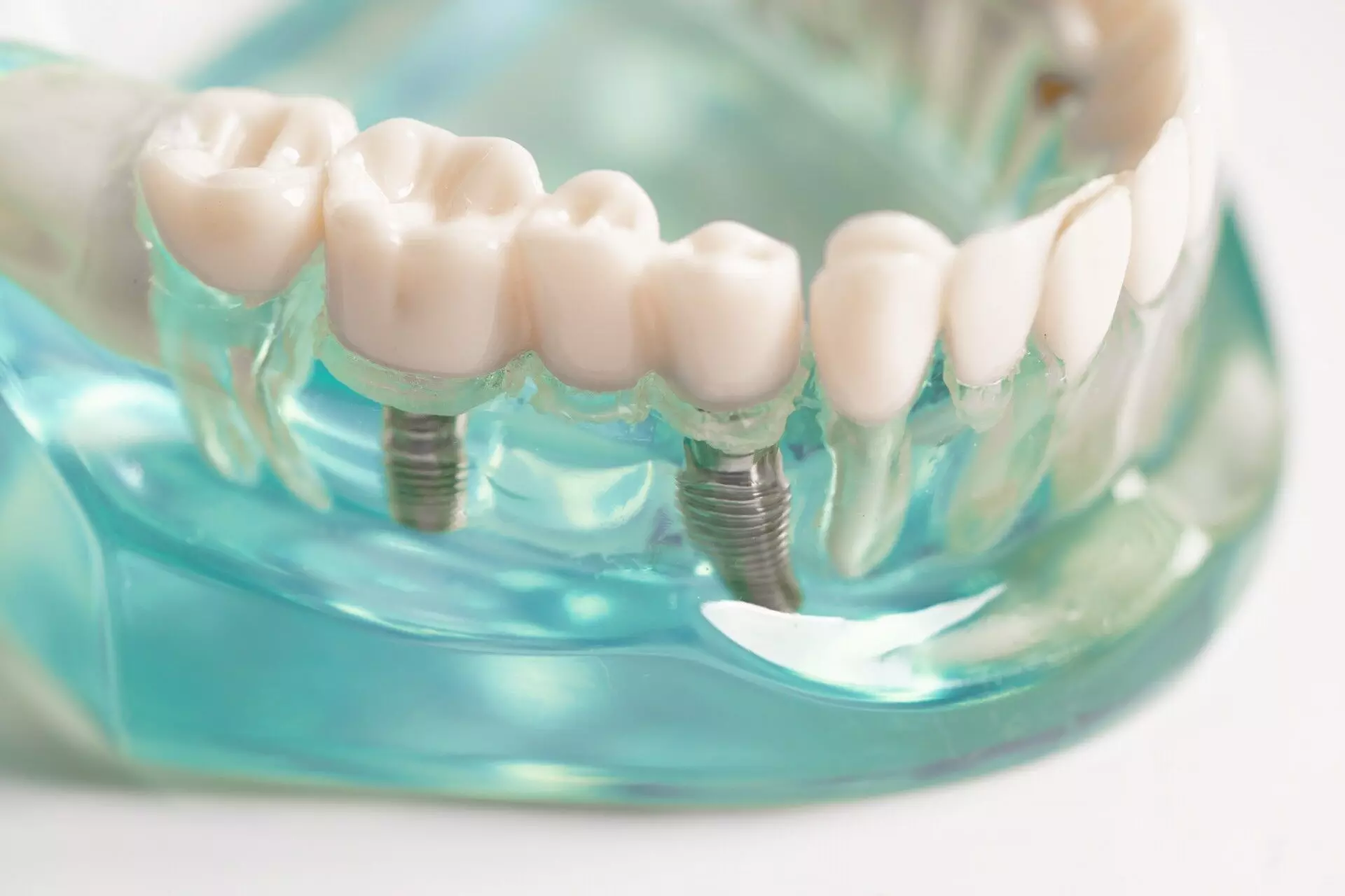 Why Dental Implants Are the Ultimate Choice for Missing Teeth