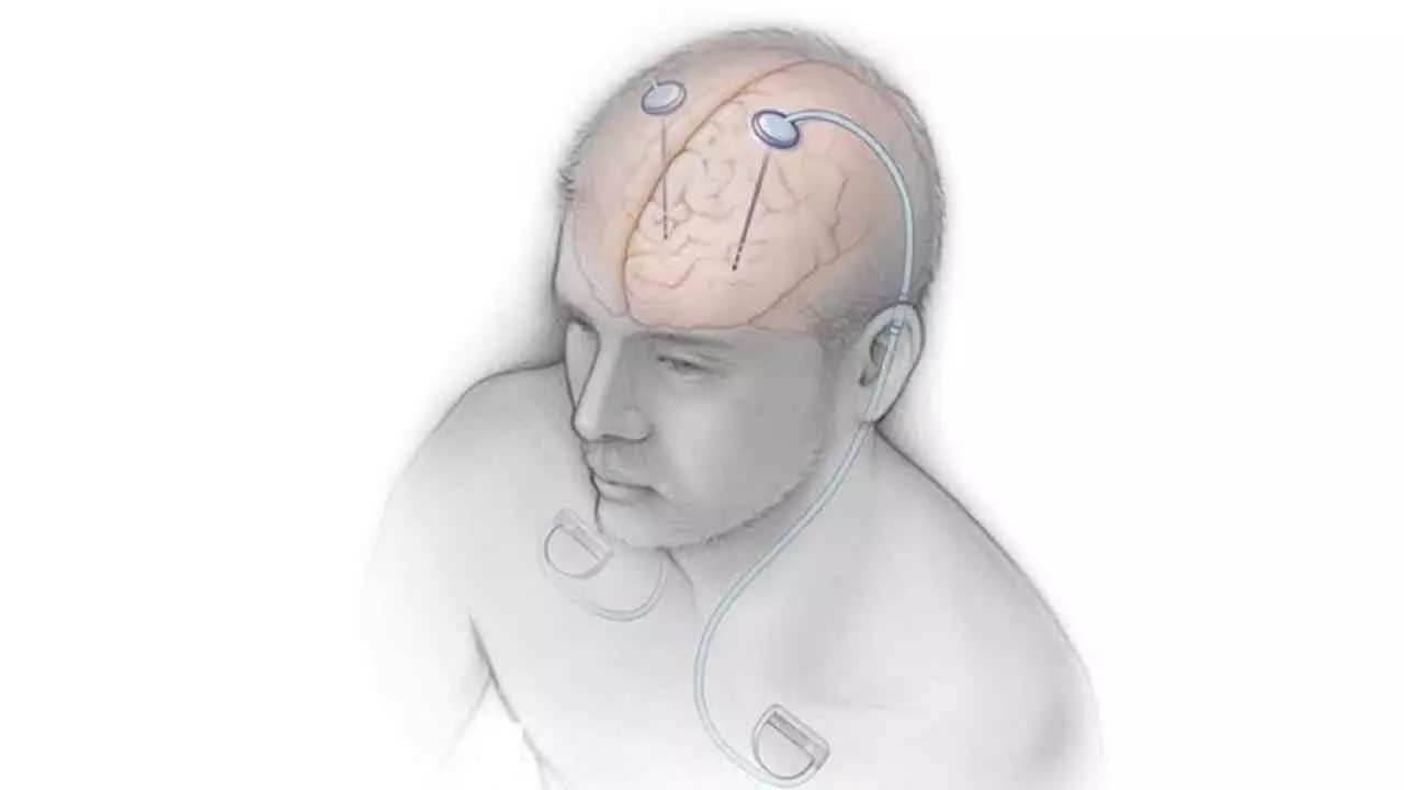 Indian Deep Brain Stimulator Market To Grow At 10% CAGR