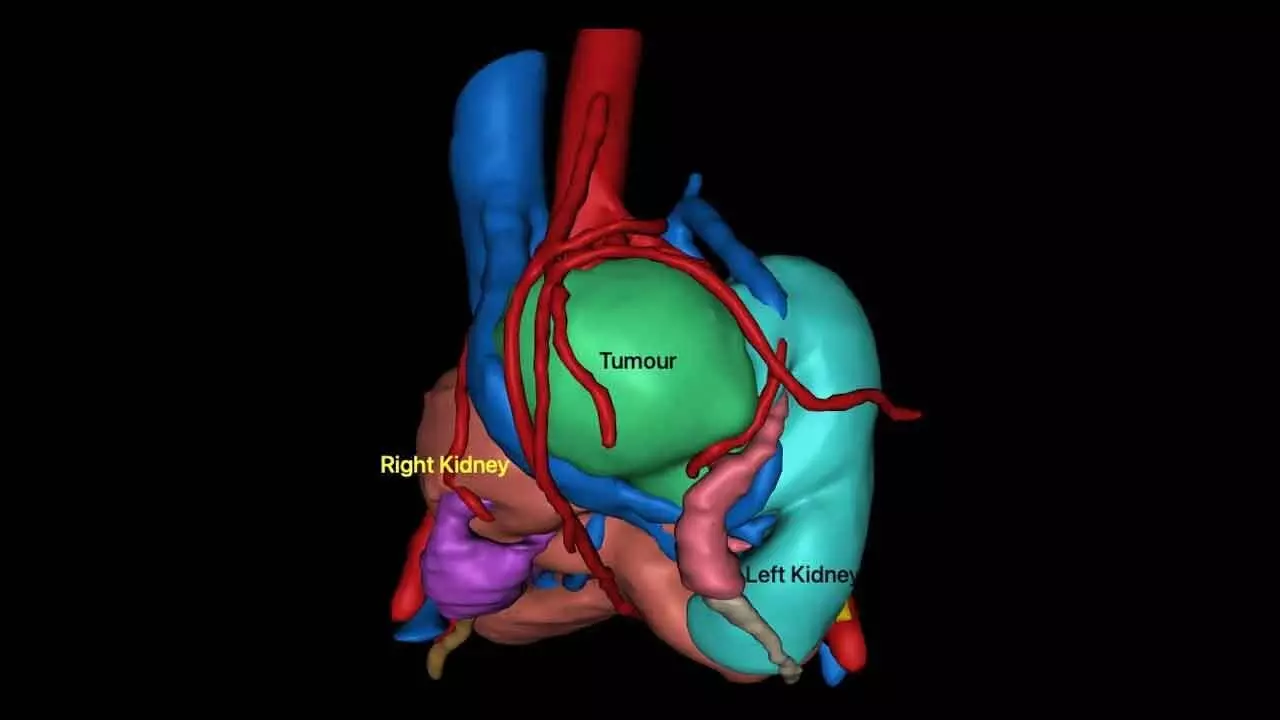 AINU Surgeons Perform Rare Keyhole Surgery