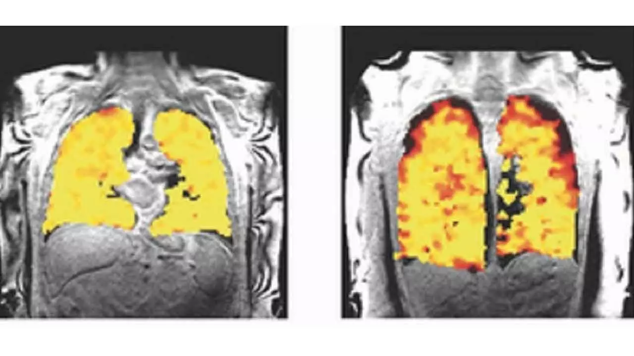 Scan That Sees Through Lung Function Developed