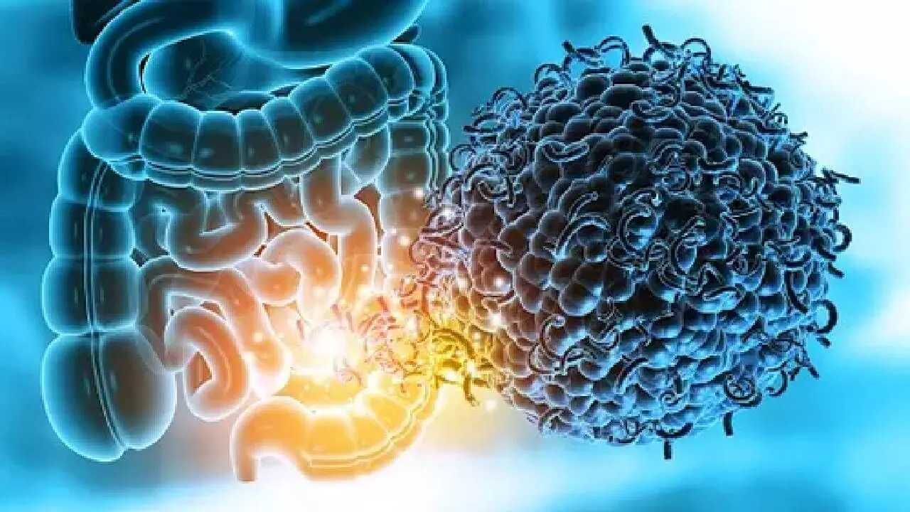 Study shows how gut microbiome raises risk of multiple sclerosis